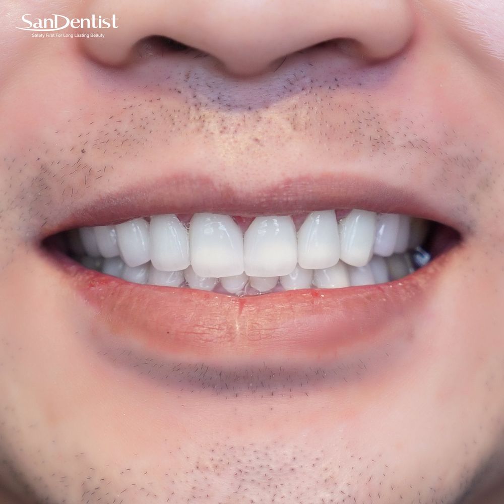 Điều trị viêm khớp thái dương hàm tại nhà như thế nào?