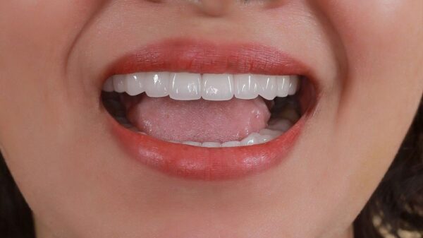 Điều trị viêm khớp thái dương hàm tại nhà như thế nào?