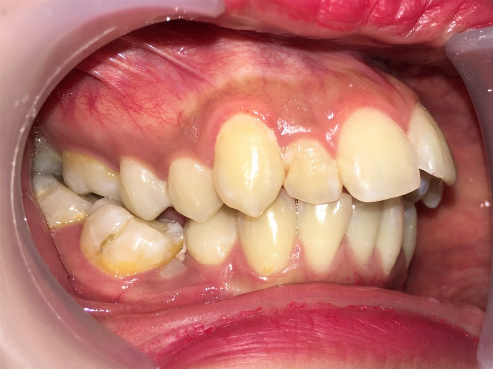 Hàm răng hô ảnh hưởng tới vận mệnh ra sao?