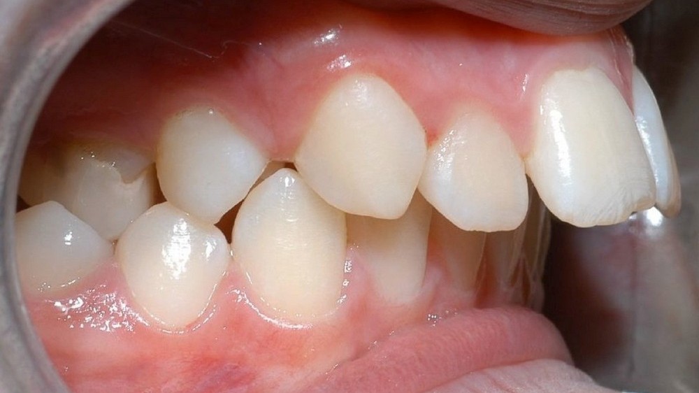 Hàm răng hô ảnh hưởng tới vận mệnh ra sao?