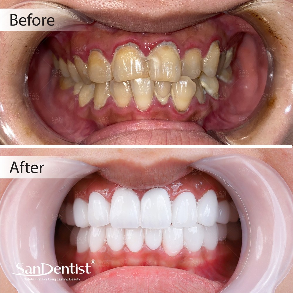 Màu sắc răng nói lên điều gì về tình hình sức khỏe?