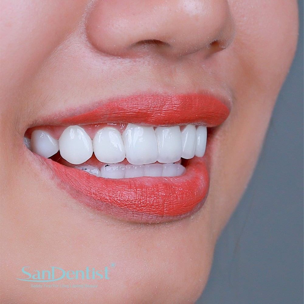 Bị viêm tủy răng do đâu? Điều trị như thế nào?