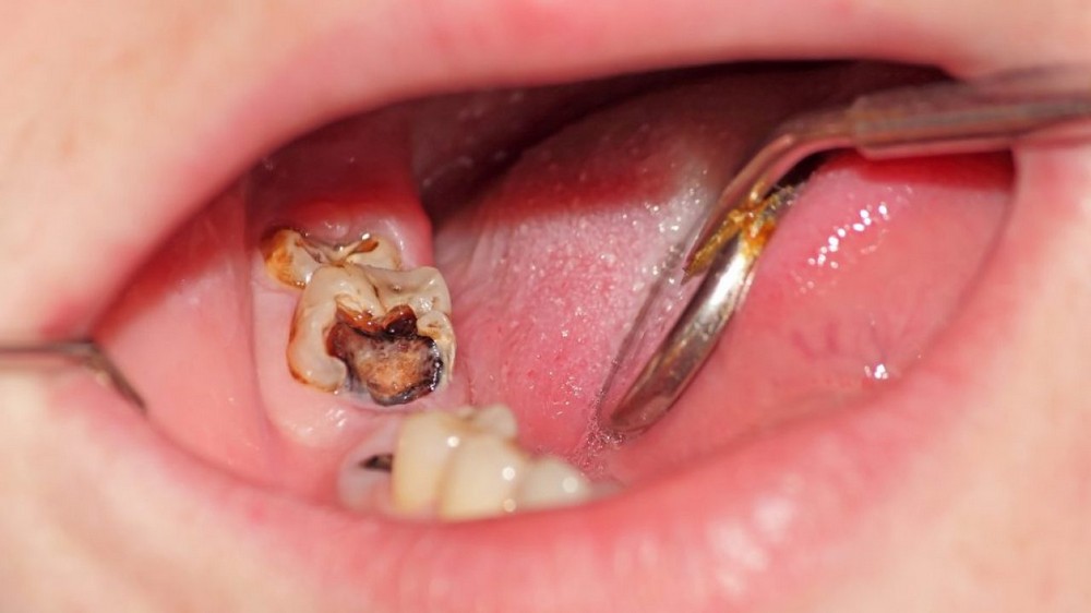 Bị viêm tủy răng do đâu? Điều trị như thế nào?