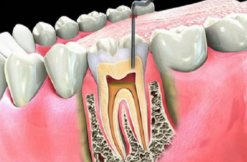 Bị viêm tủy răng do đâu? Điều trị như thế nào?