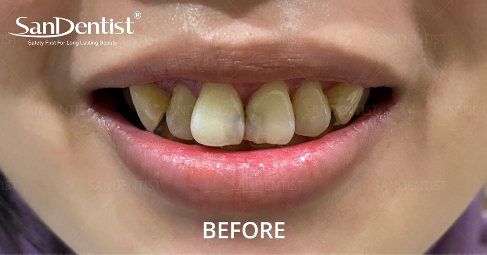 Răng bị lão hóa sẽ gây ra nhiều bệnh nguy hiểm!