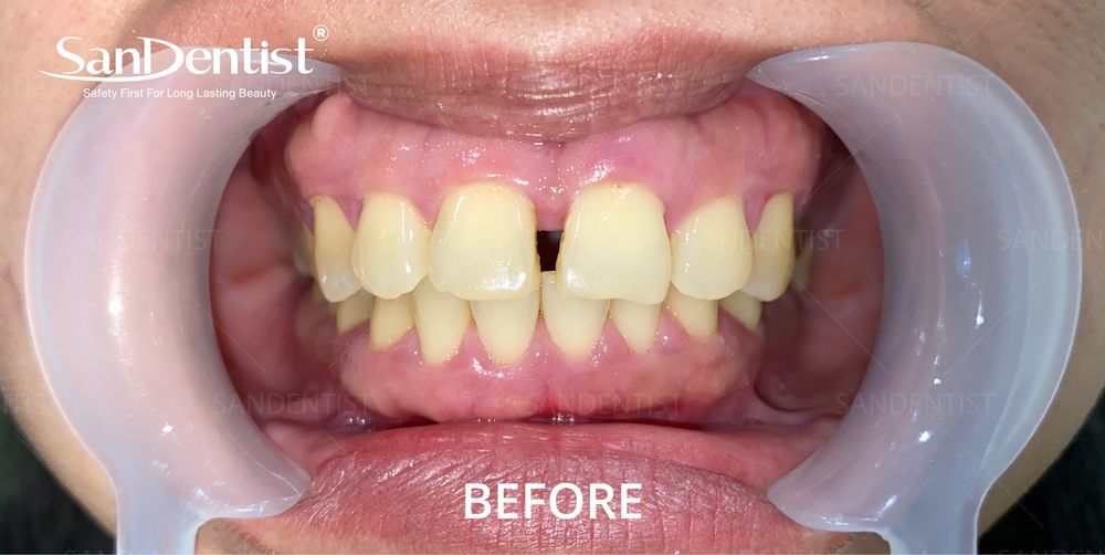 Răng bị lão hóa sẽ gây ra nhiều bệnh nguy hiểm!