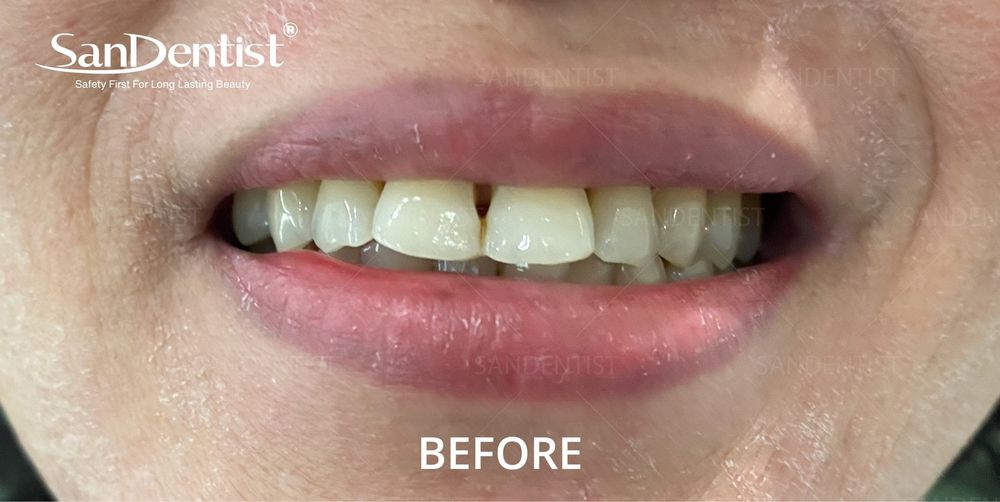 Răng bị lão hóa sẽ gây ra nhiều bệnh nguy hiểm!