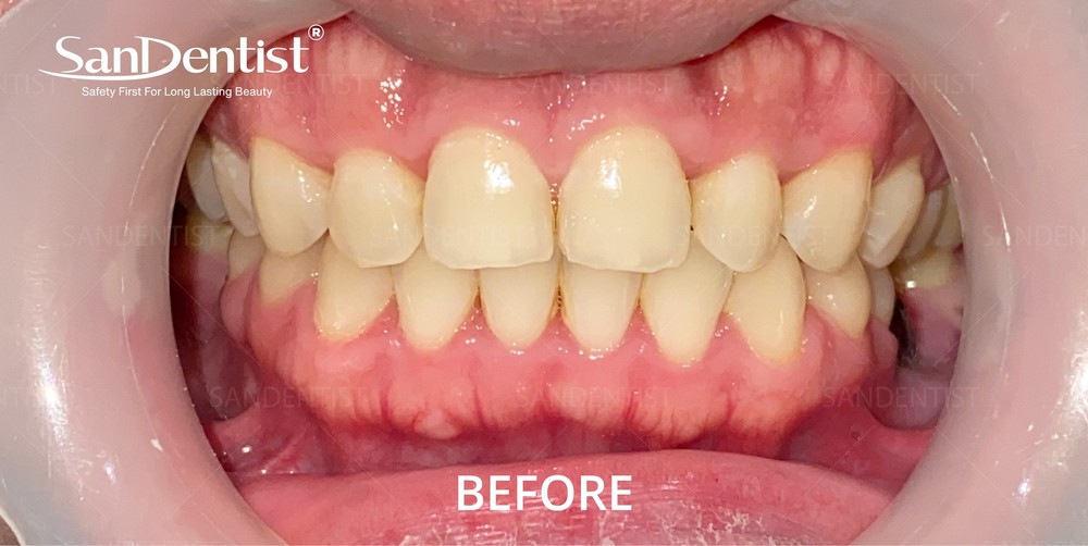 Răng cửa to: Vận mệnh liệu có huy hoàng?