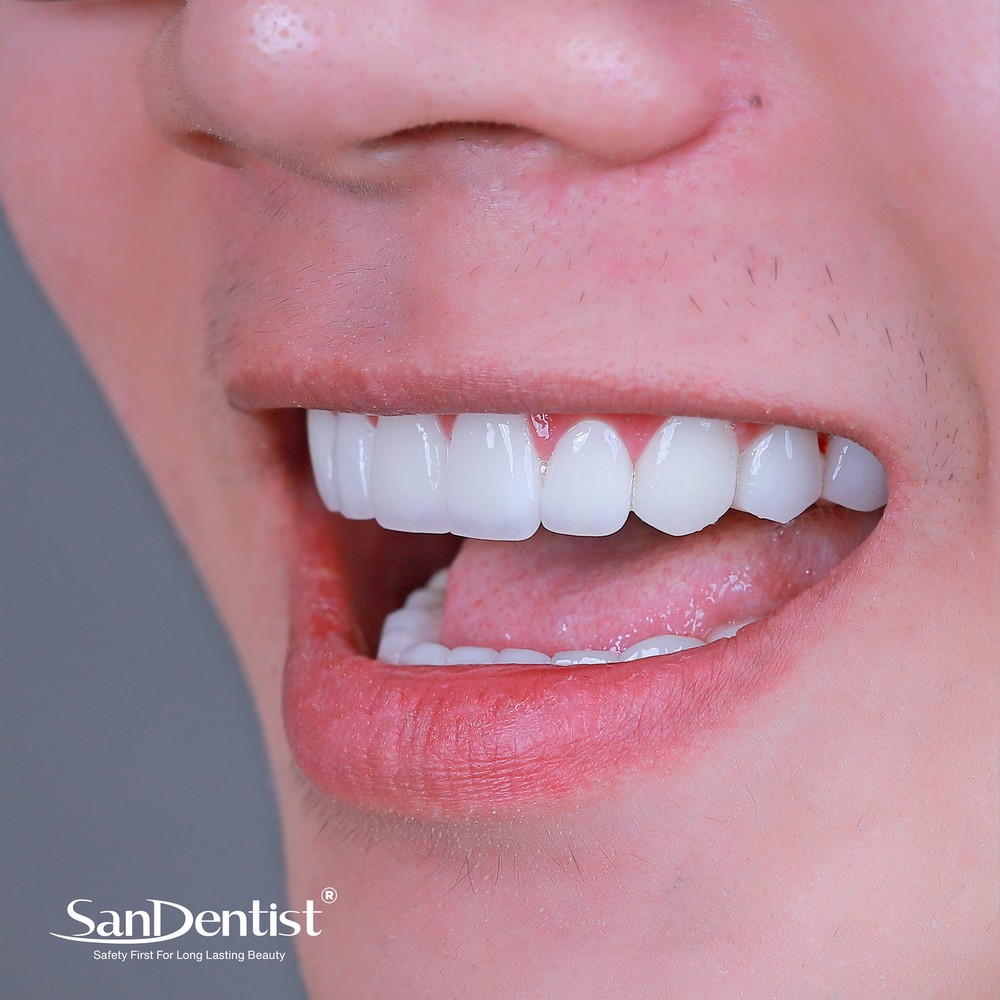 Răng cửa to: Vận mệnh liệu có huy hoàng?