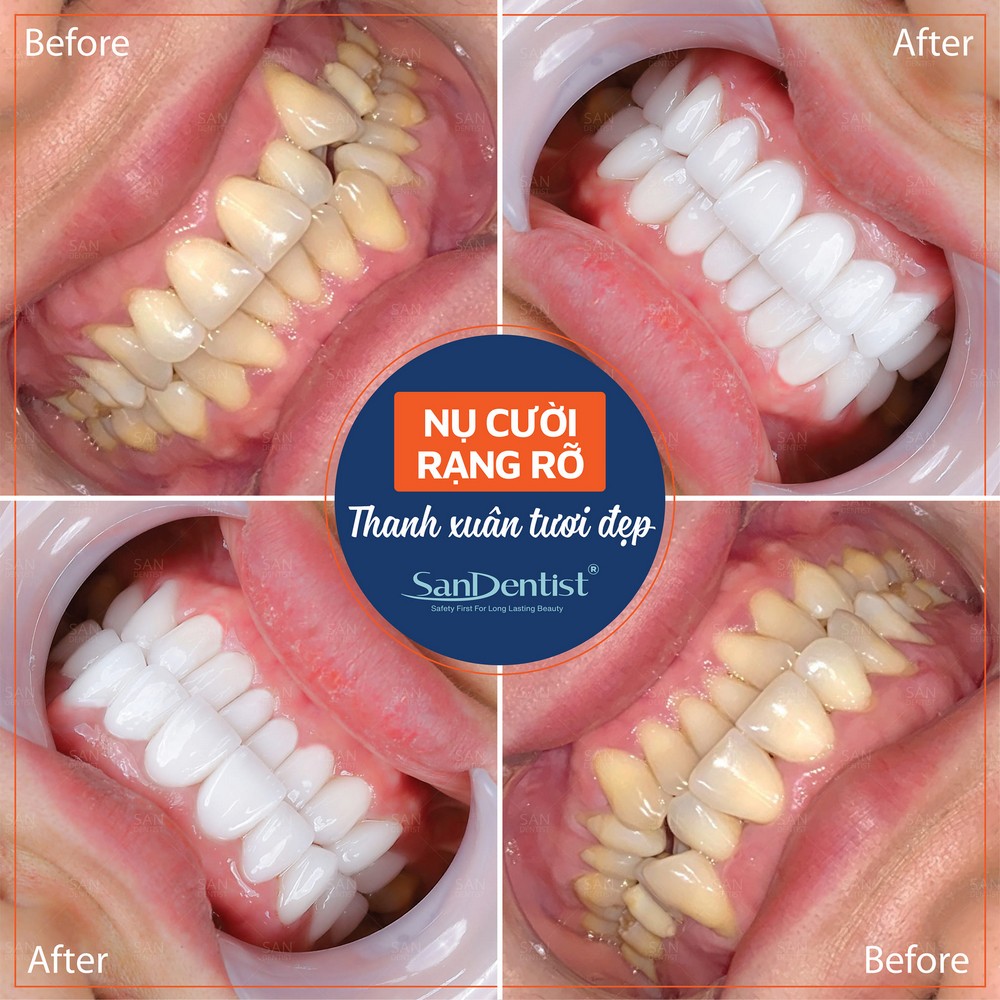 Răng đều như hạt bắp: Tiêu chuẩn thẩm mỹ và phong thủy