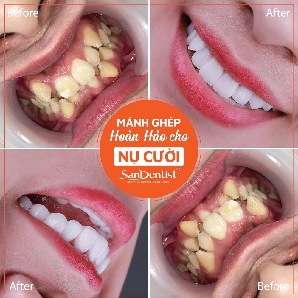 Hàm răng mọc lệch có làm "lệch" số phận?