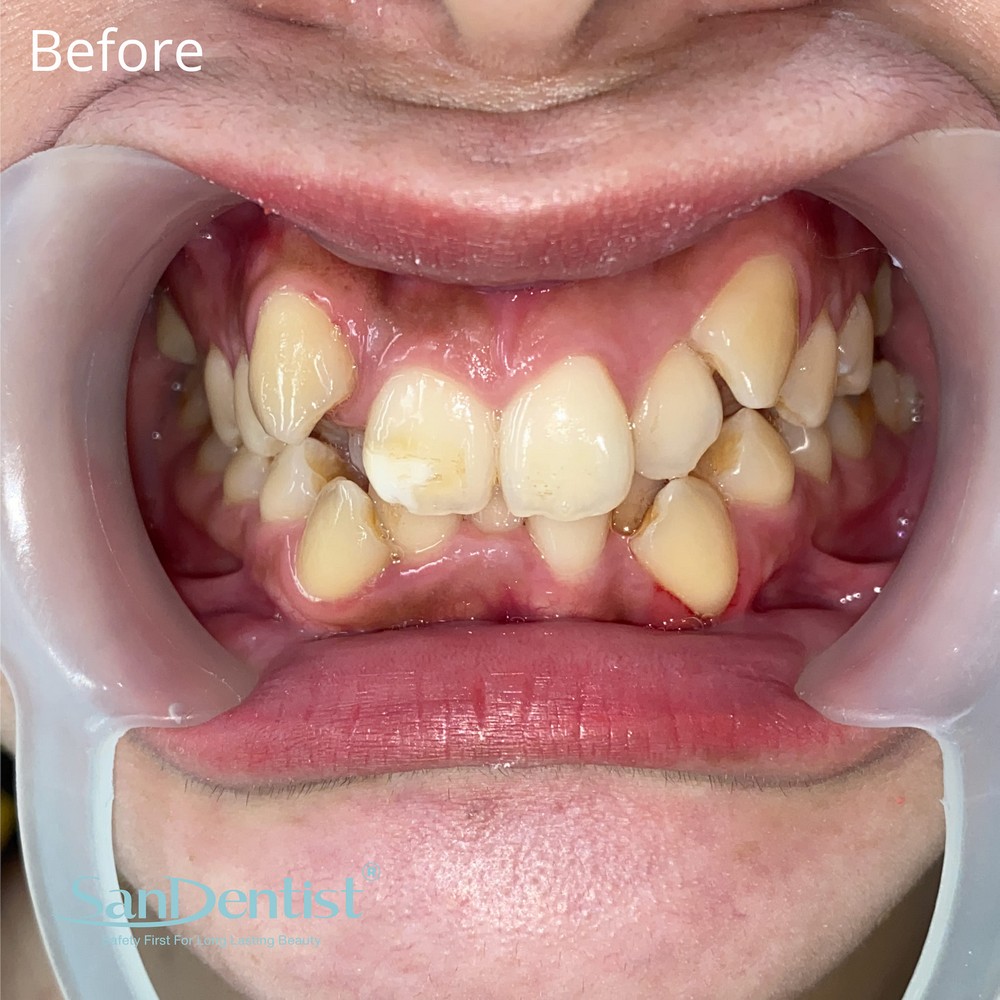 Hàm răng mọc lệch có làm "lệch" số phận?