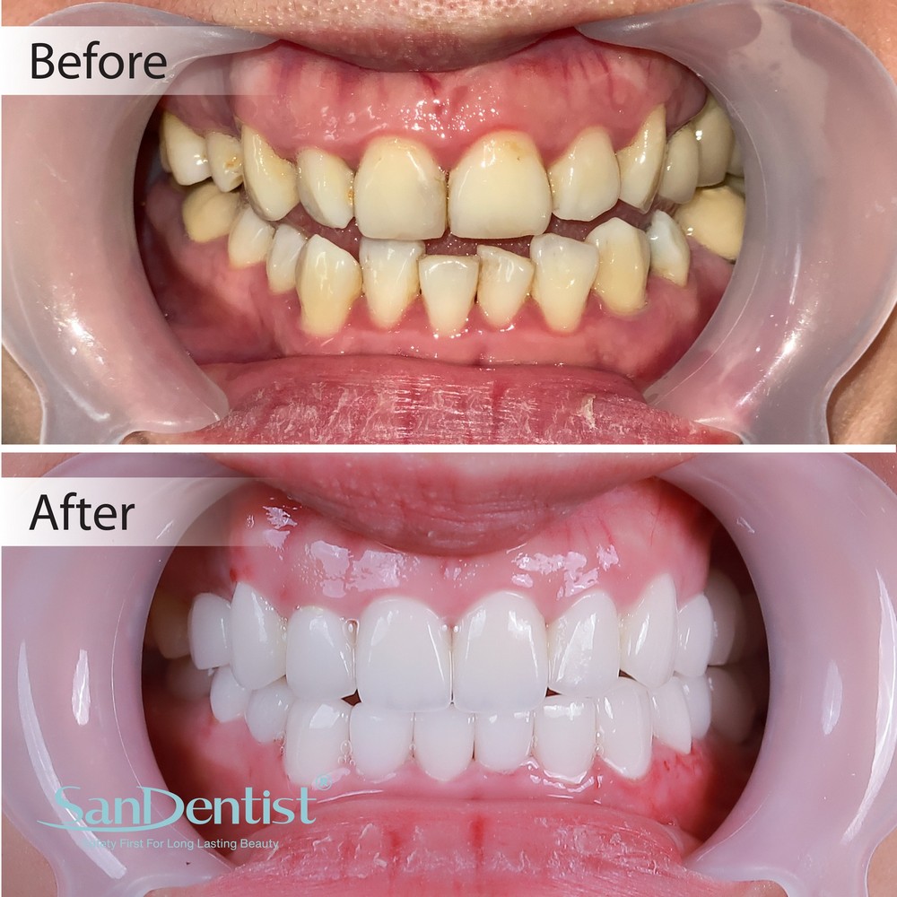 Hàm răng mọc lệch có làm "lệch" số phận?