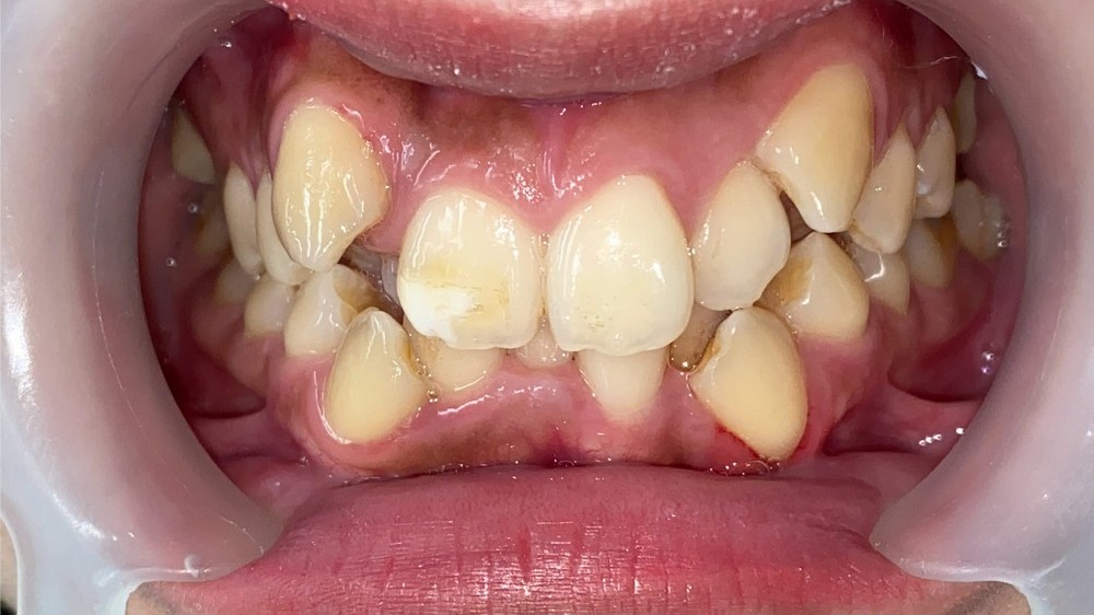 Hàm răng mọc lệch có làm "lệch" số phận?