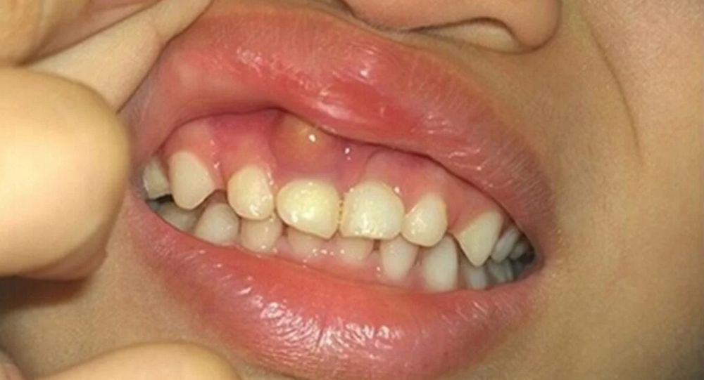 Sưng lợi sau khi ăn: Coi chừng biến chứng nguy hiểm!