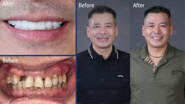 Sưng lợi sau khi ăn: Coi chừng biến chứng nguy hiểm!