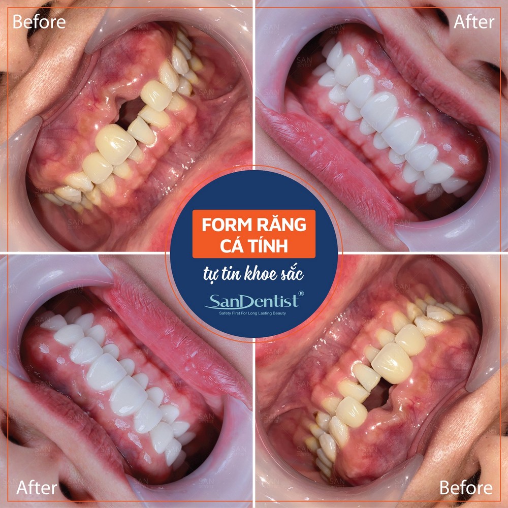 Thực hư chuyện "lên đời đổi vận" nhờ nhổ răng?