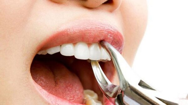 Thực hư chuyện "lên đời đổi vận" nhờ nhổ răng?