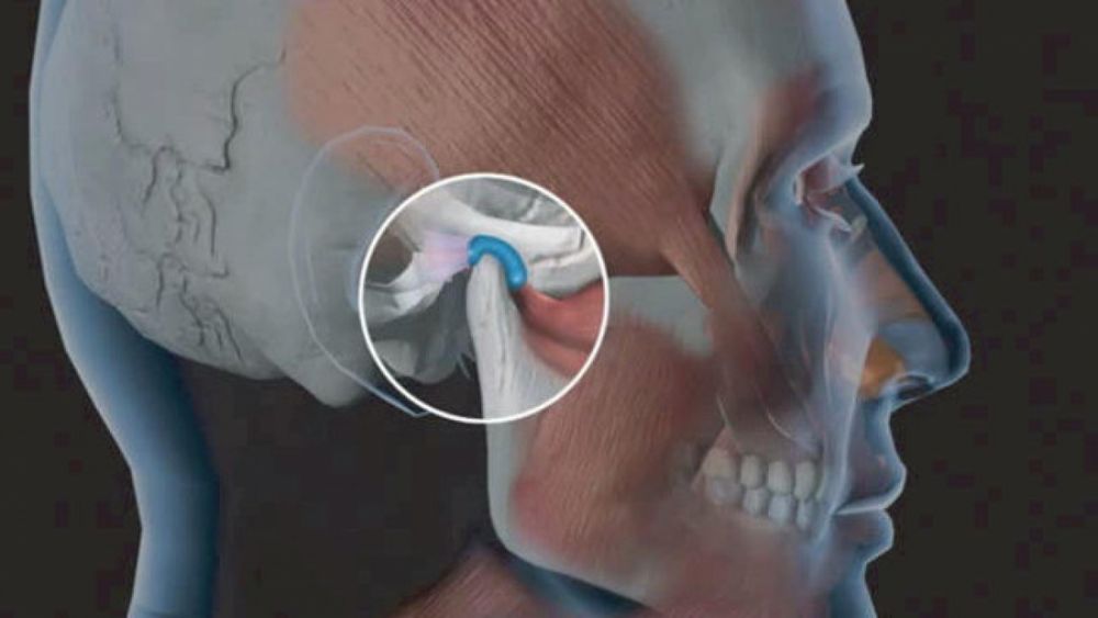 Bệnh viêm khớp thái dương hàm: Có thể tự khỏi không?
