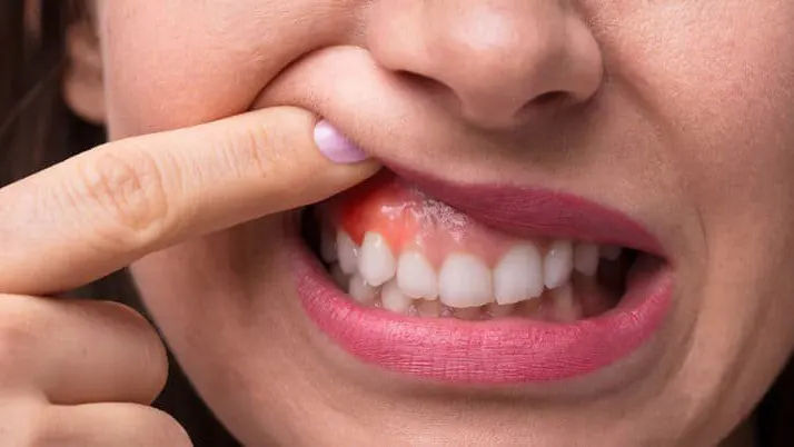 Bệnh viêm chân răng: Nguyên nhân và cách điều trị