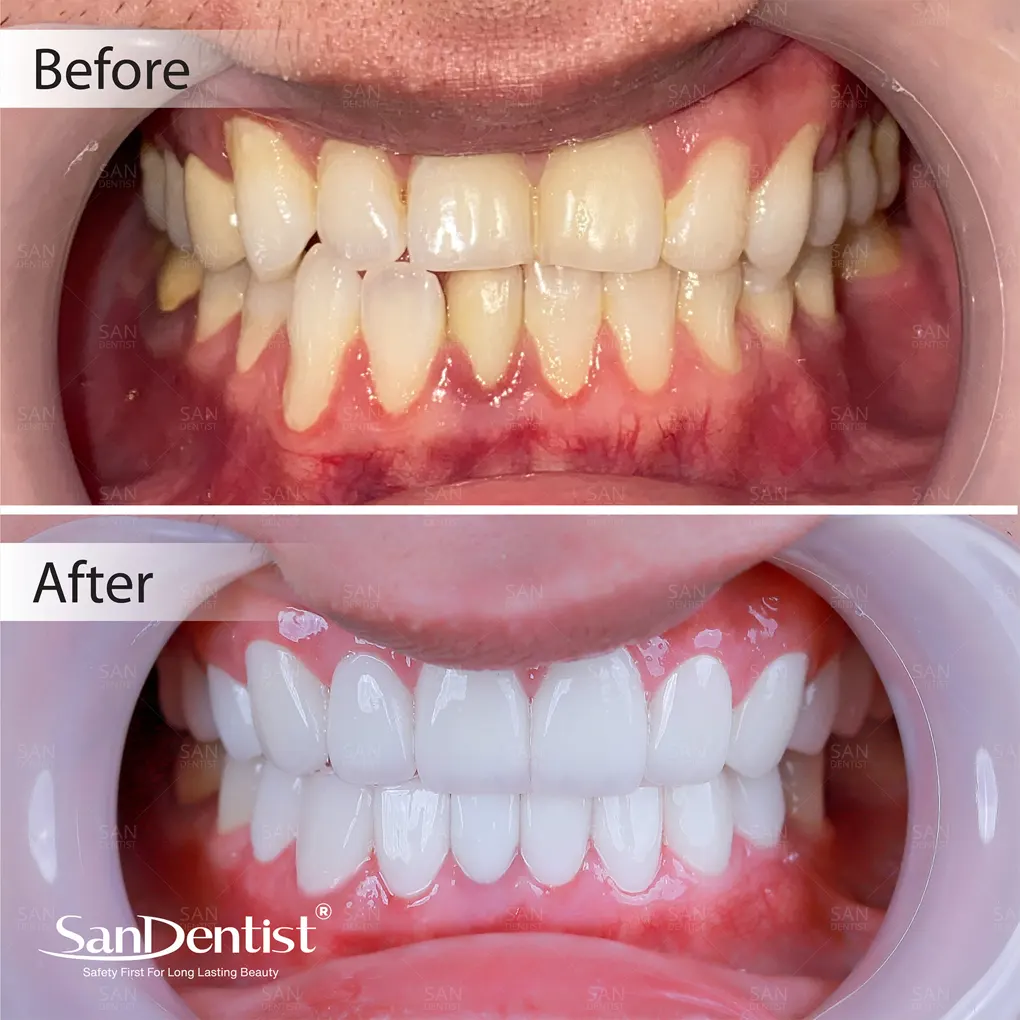 Bị tụt lợi có nên phủ răng sứ hay không?