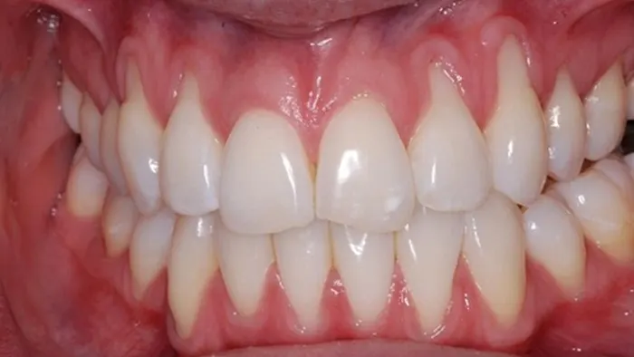 Bị tụt lợi có nên phủ răng sứ hay không?