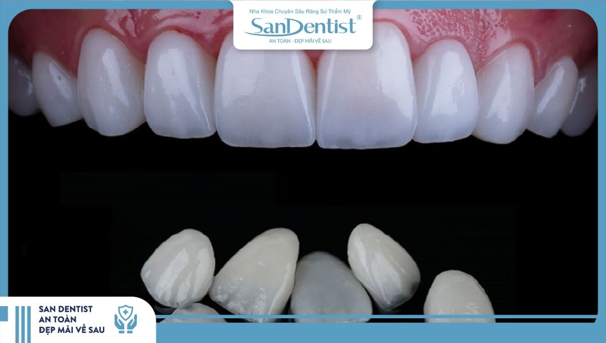 Các loại răng sứ phổ biến được dụng trong phương pháp phủ răng sứ