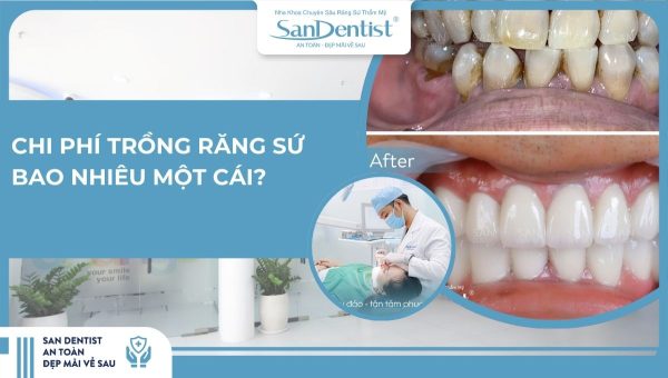 Chi phí trồng răng sứ bao nhiêu một cái