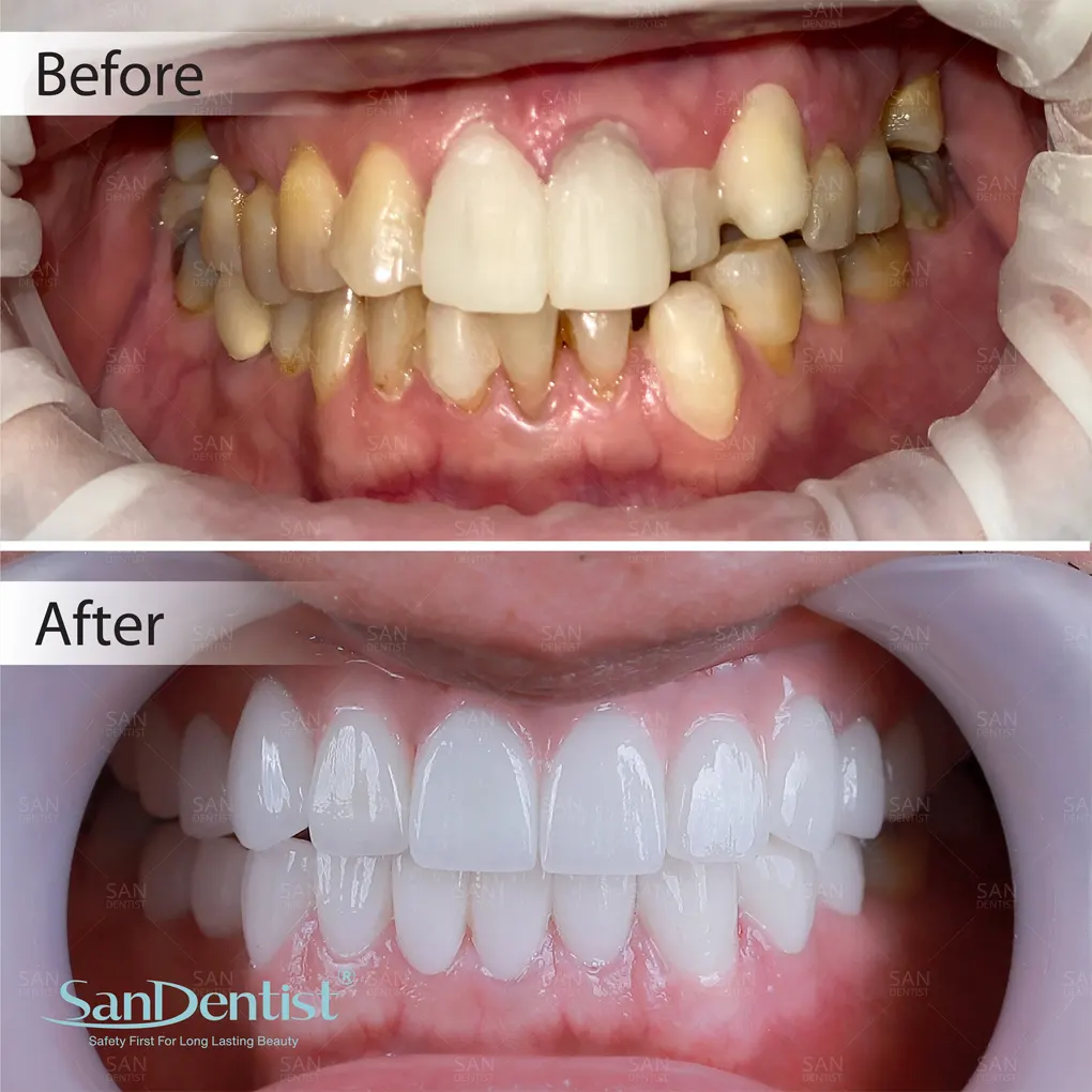 Nhiễm trùng răng miệng có gây viêm khớp không?