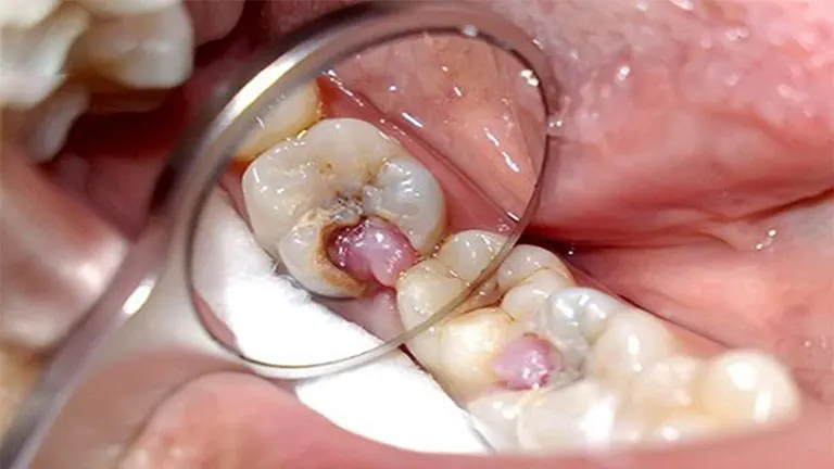 Nhiễm trùng răng miệng có gây viêm khớp không?