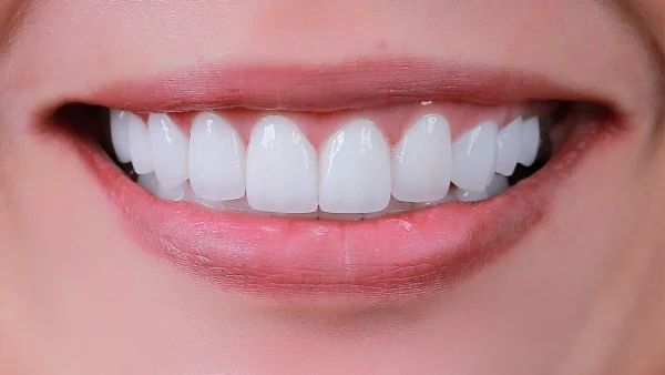Phủ sứ thẩm mỹ cho hàm hô có hiệu quả không?