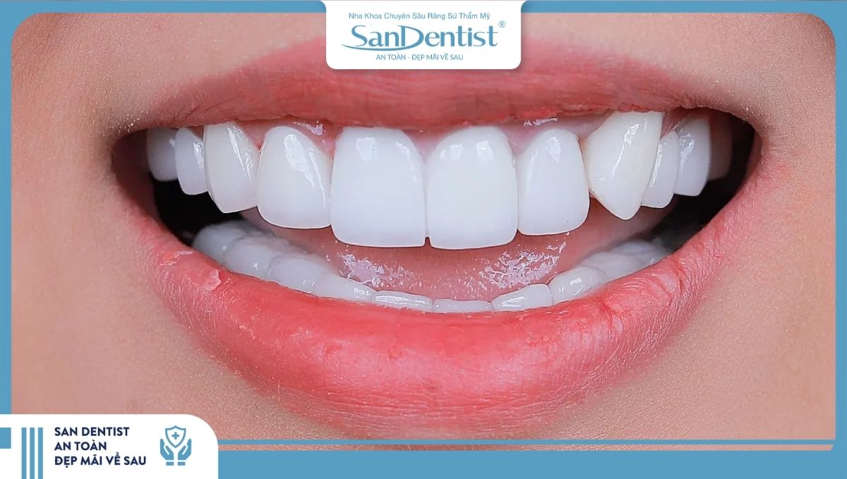 Phương pháp phủ sứ răng thưa giúp mang lại nụ cười tự tin