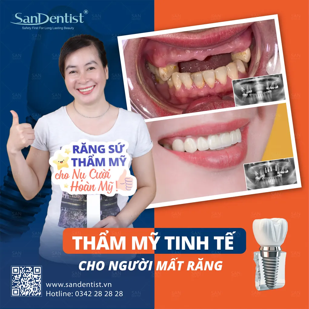 Tìm hiểu về phương pháp trồng răng vĩnh viễn