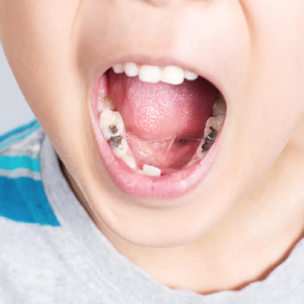 Trẻ bị hôi miệng: nguyên nhân và cách khắc phục