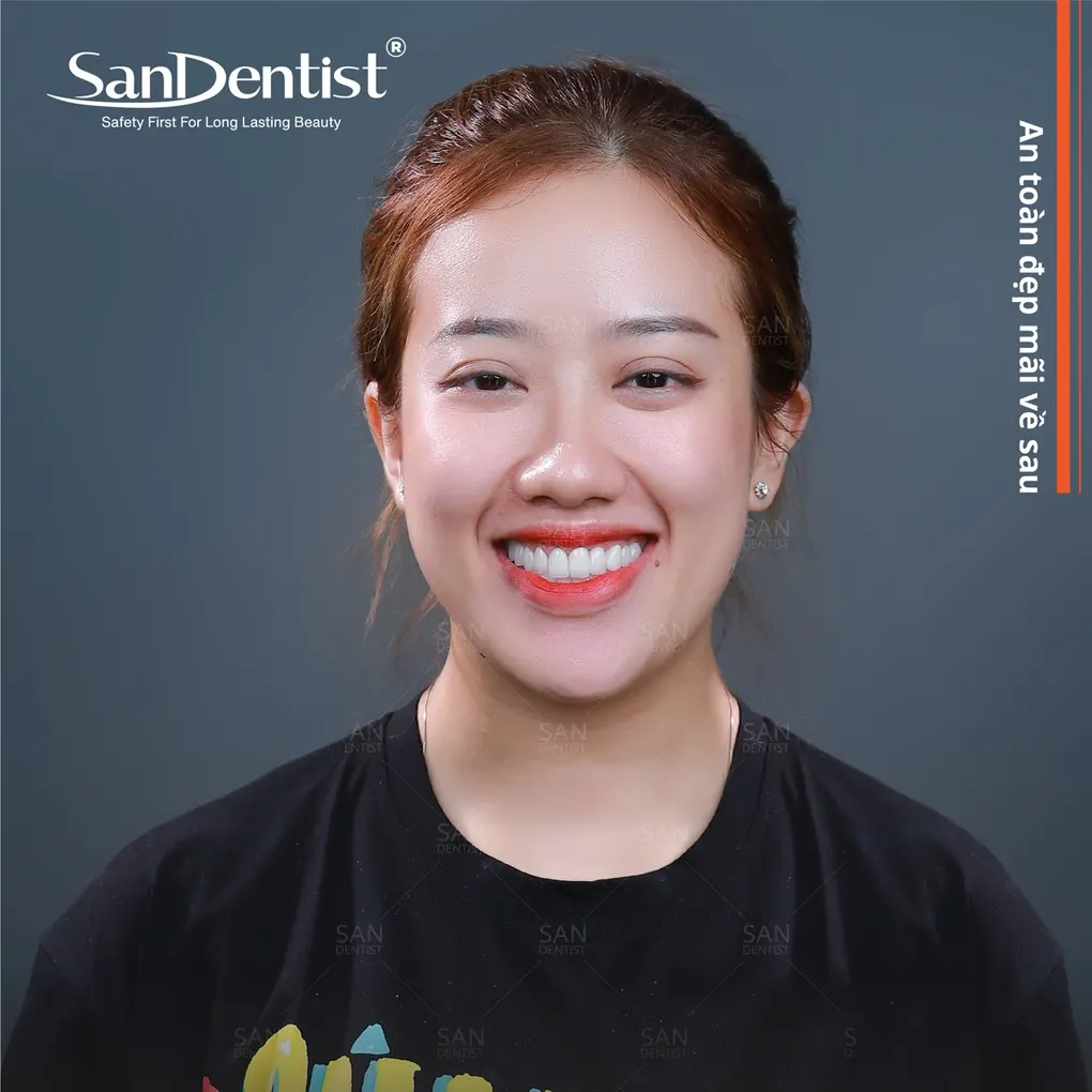 Trồng răng cửa cần thời gian bao lâu?