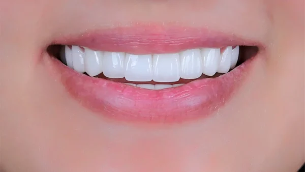 Trồng răng cửa cần thời gian bao lâu?