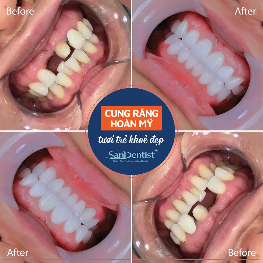 Trồng răng cửa cần thời gian bao lâu?