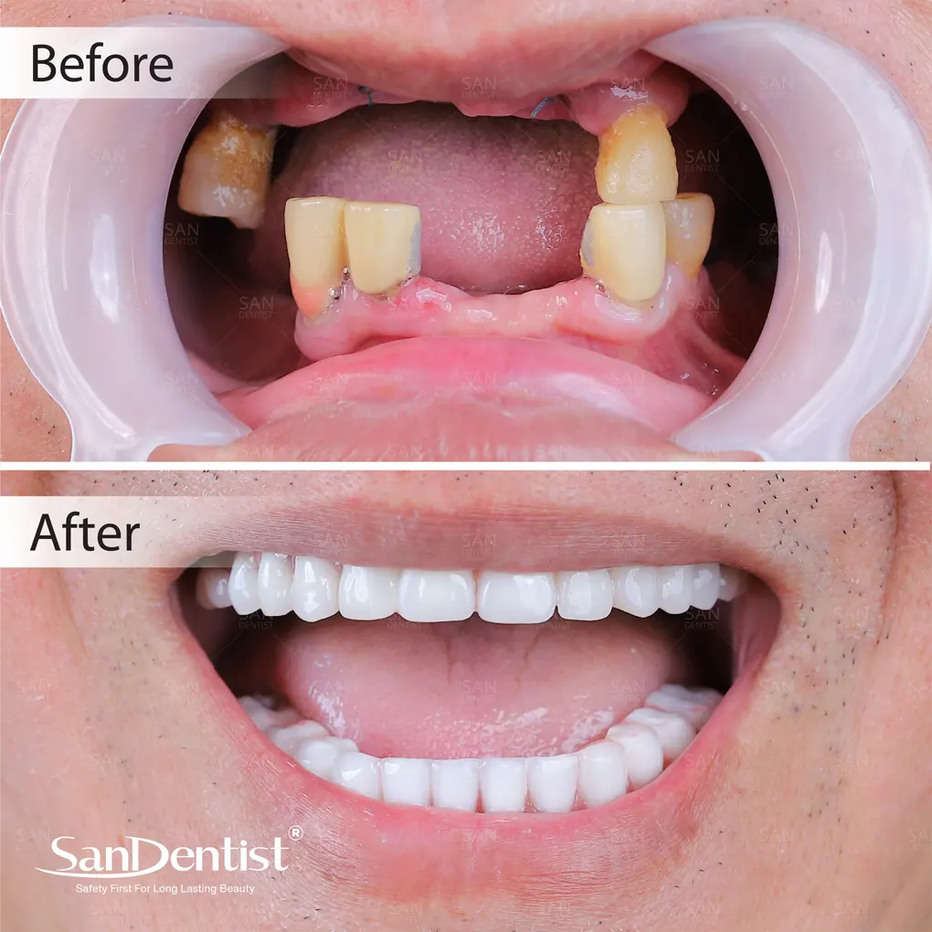 Chi phí trồng răng một cái khoảng bao nhiêu tiền?