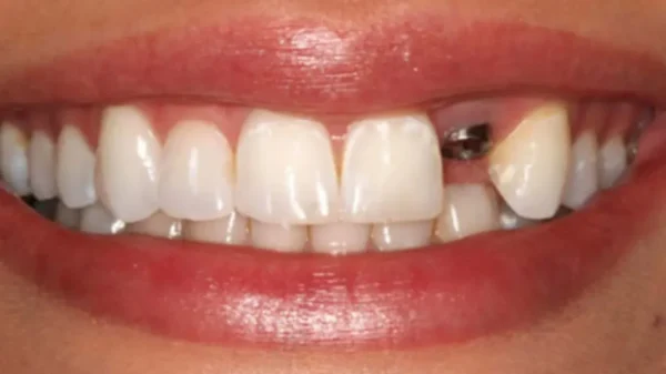 Trồng răng nanh có cần thiết hay không?