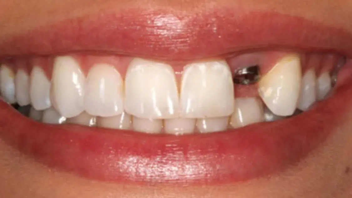 Trồng răng nanh có cần thiết hay không?