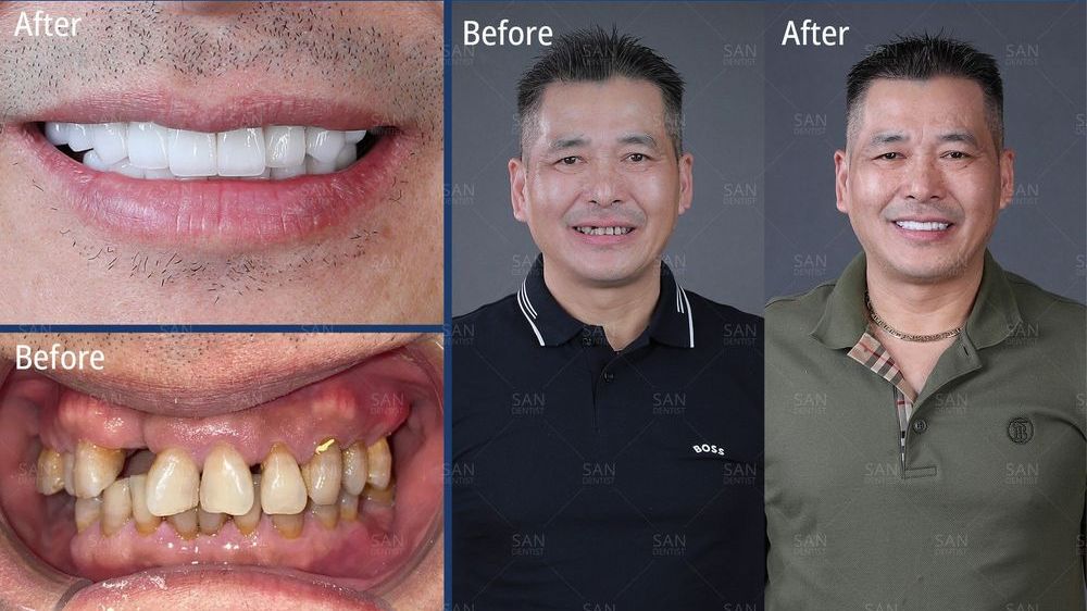 Cấy ghép răng Implant phù hợp với đối tượng nào?