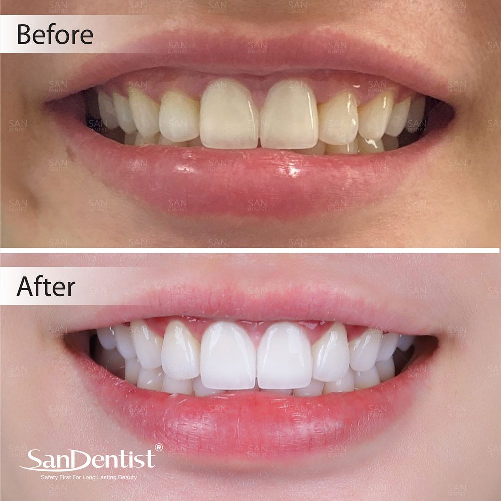 Diệt tủy răng có ảnh hưởng đến sức khỏe răng miệng không?