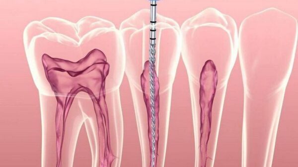 Diệt tủy răng có ảnh hưởng đến sức khỏe răng miệng không?