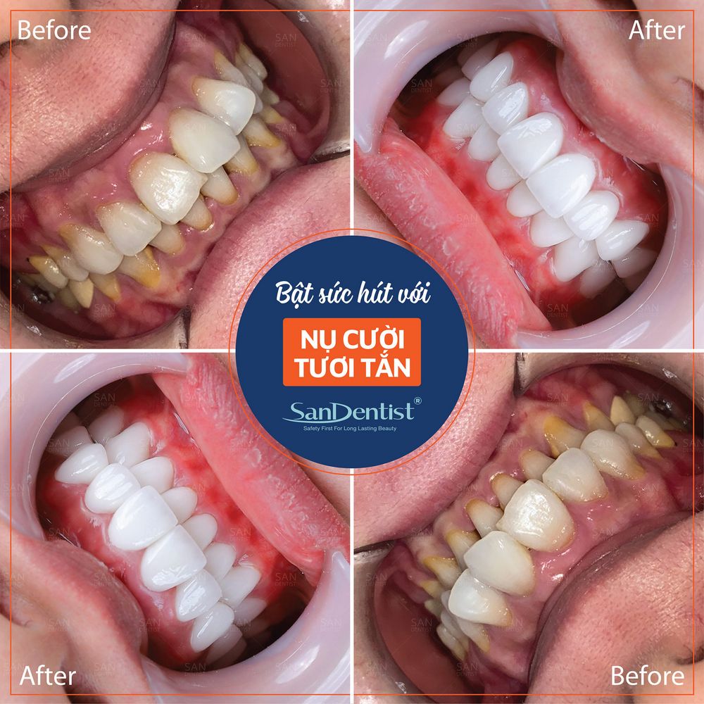 Chân răng bị vàng: Điều trị ra sao để lấy lại vẻ đẹp?