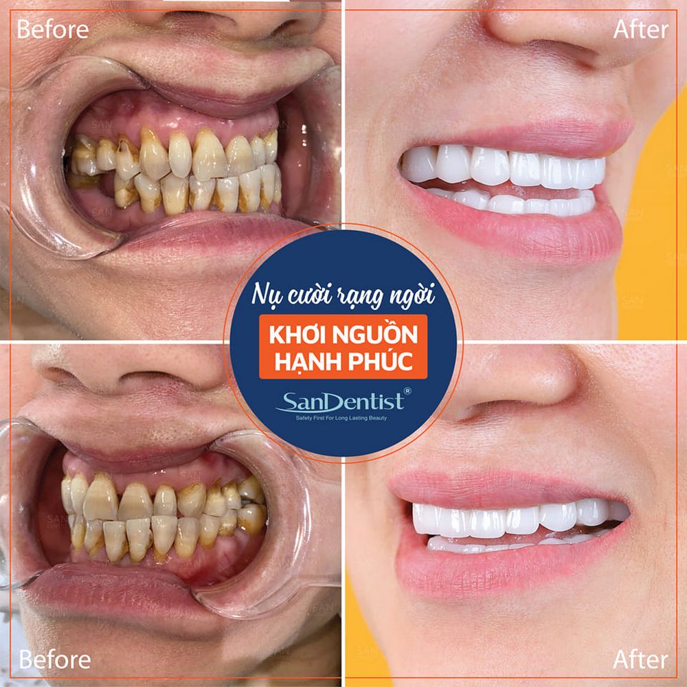 Chân răng bị vàng: Điều trị ra sao để lấy lại vẻ đẹp?