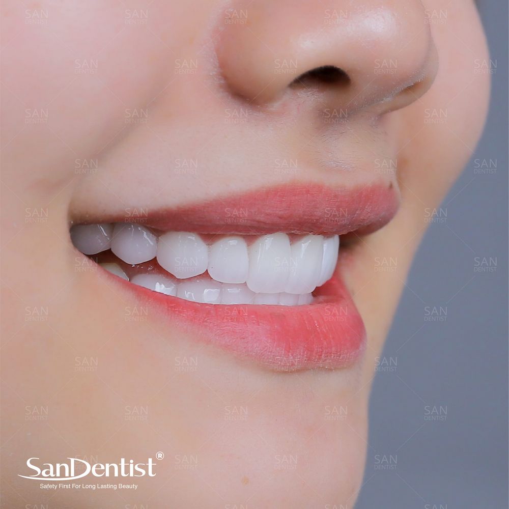 Cạo vôi đánh bóng răng cần lưu ý gì?