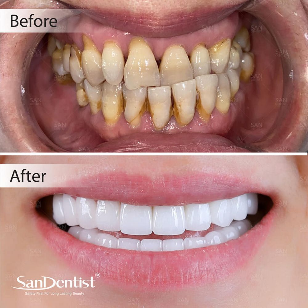 Cạo vôi đánh bóng răng cần lưu ý gì?