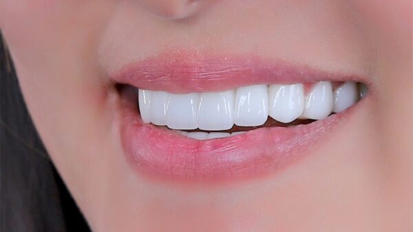 Tháng cô hồn có nên làm răng sứ thẩm mỹ không?