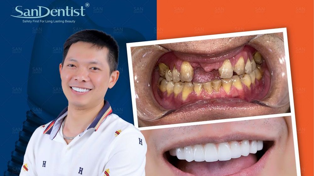 Trồng răng sứ Implant và những điều cần lưu ý