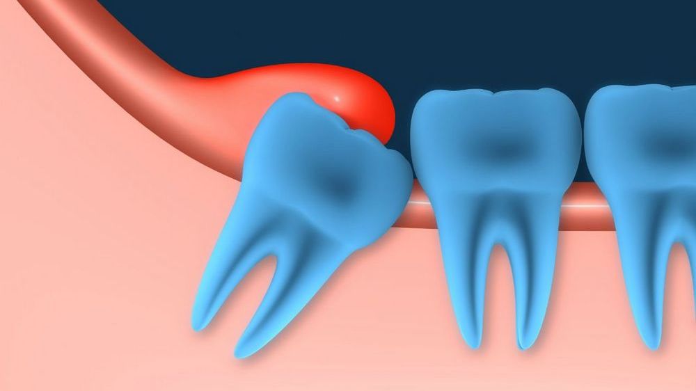 Bệnh viêm lợi trùm răng khôn là gì? Điều trị ra sao?